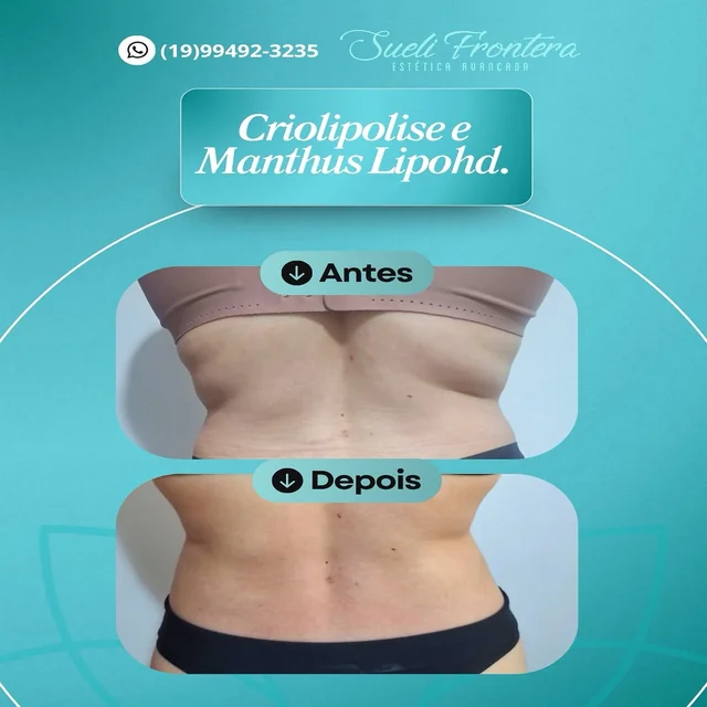 Antes e depois — Criolipólise e Manthus Lipohd